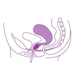 ELANEE pelvic floor training aids Phase II